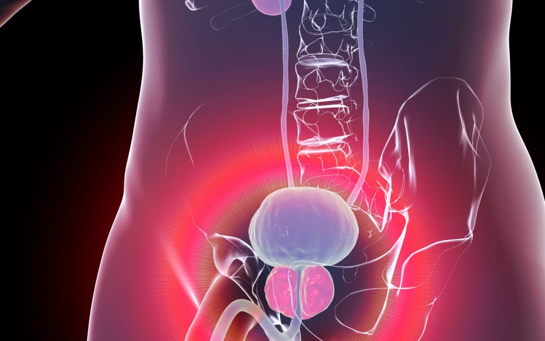 L’embolisation des artères prostatiques : une approche thérapeutique nouvelle chez les patients porteurs d’un adénome de la prostate