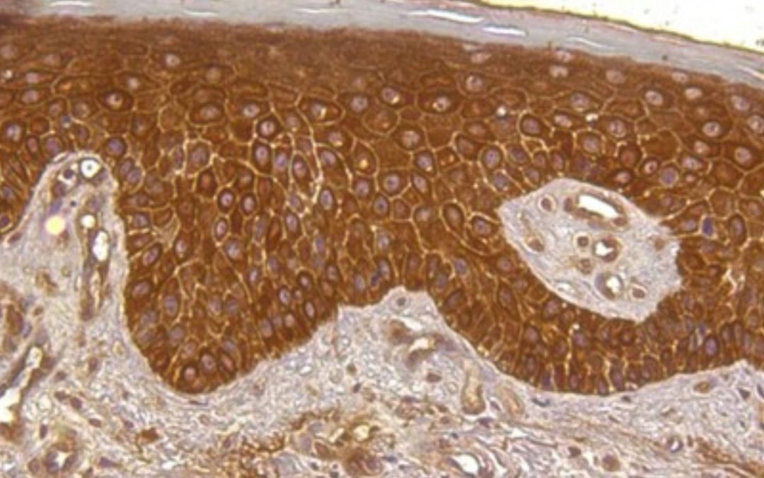 L’hepcidine, hormone du fer dans la peau : nouvelle cible dans le traitement du psoriasis ?