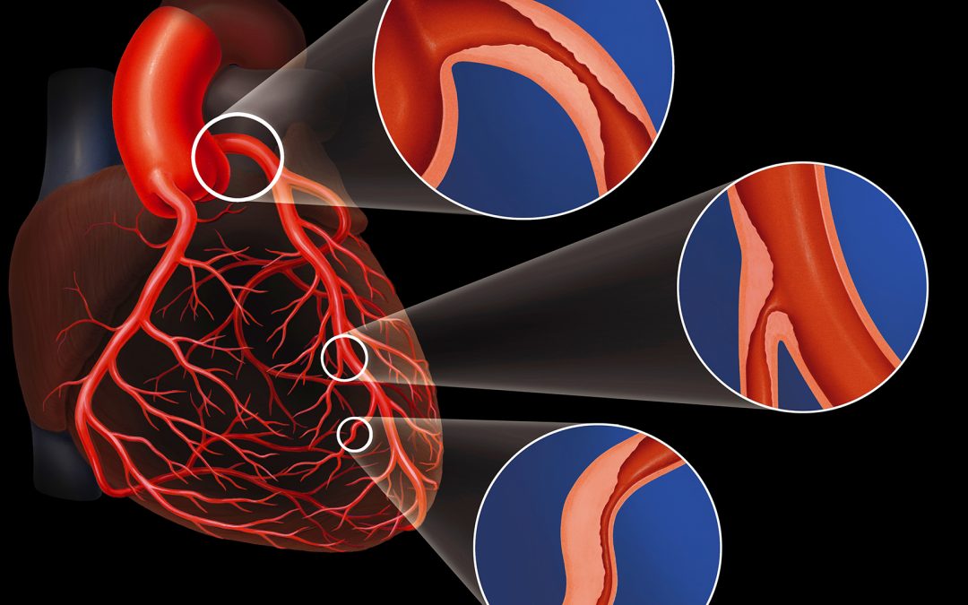 Premiers résultats d’un traitement novateur non invasif de la sténose valvulaire aortique