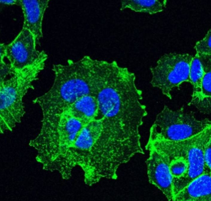 La présence de polluants dans l’organisme renforce l’agressivité des cancers du sein