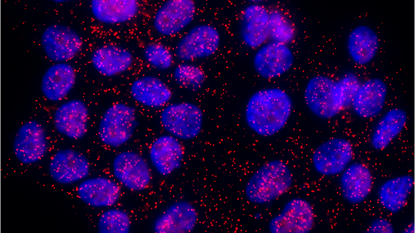 Cancer luminal du sein : une nouvelle association de protéines inhibe l’apparition de métastases