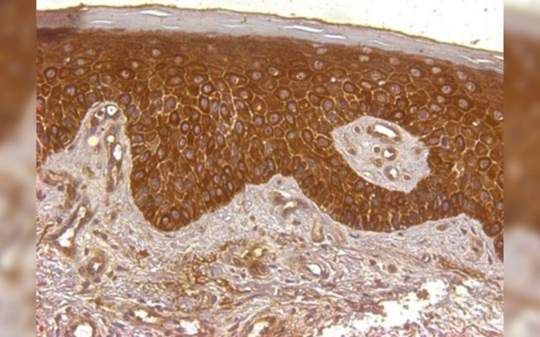 L’hepcidine, hormone du fer dans la peau : nouvelle cible dans le traitement du psoriasis ?