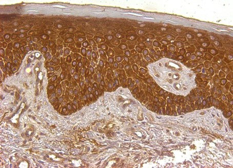 L’hepcidine, hormone du fer dans la peau : nouvelle cible dans le traitement du psoriasis ?